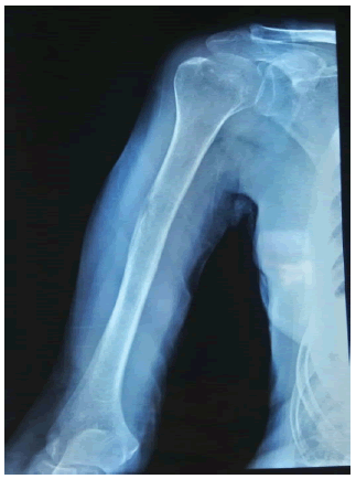 intramuscular-myxoma-humerus