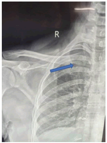 intramuscular-myxoma-leiosn