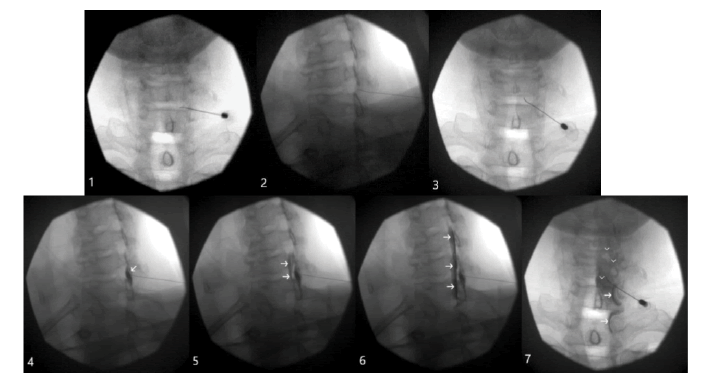 intramuscular-myxoma-navigation