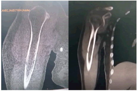 intramuscular-myxoma-parenchymal