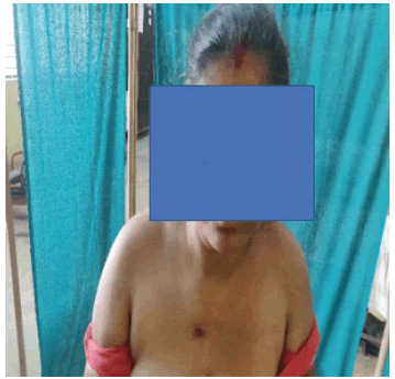 intramuscular-myxoma-showing