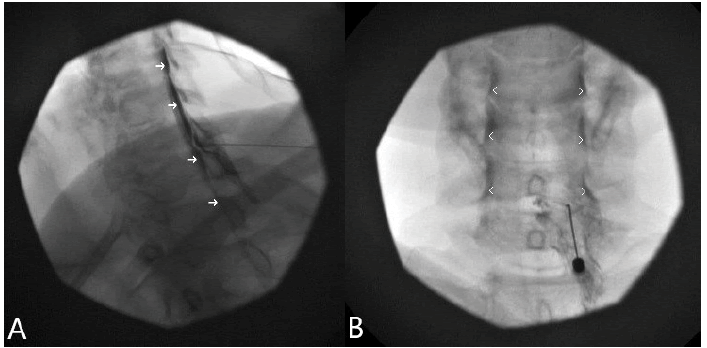 intramuscular-myxoma-subdural