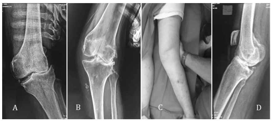 intramuscular-myxoma-sufficient