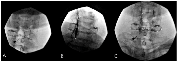 intramuscular-myxoma-while