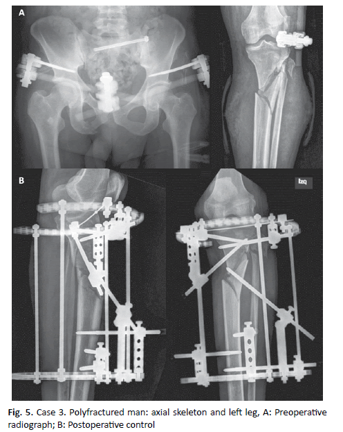 jotsrr-axial-skeleton