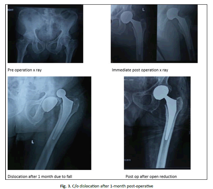 jotsrr-dislocation