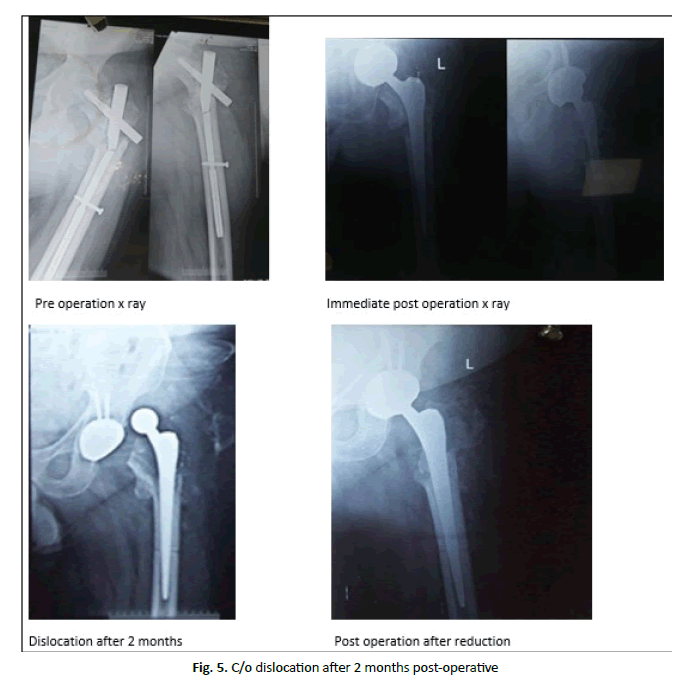 jotsrr-post-operative