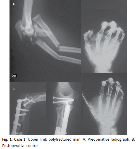 jotsrr-upper-limb