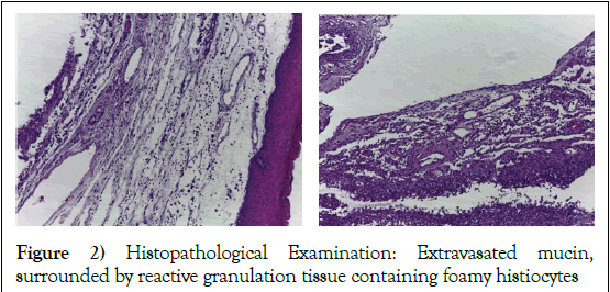 journal-dental-oral-research-foamy-histiocytes