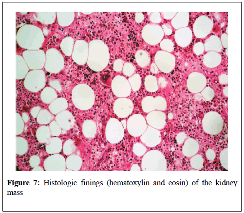 kidney-treatment-diagnosis-Histologic-finings