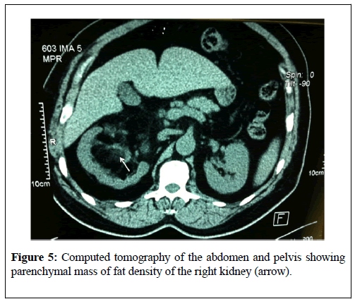kidney-treatment-diagnosis-fat-density
