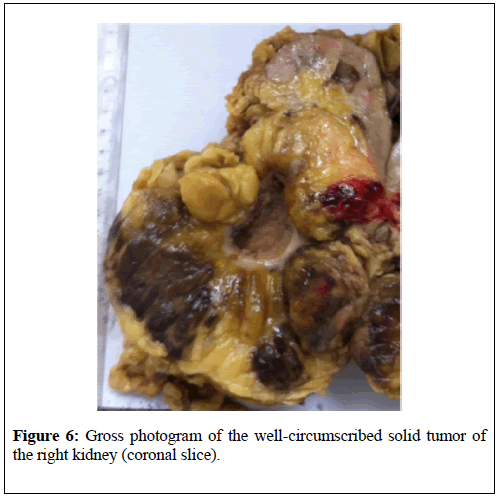 kidney-treatment-diagnosis-solid-tumor