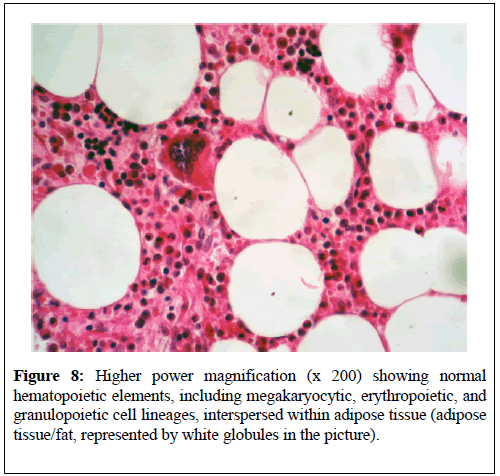 kidney-treatment-diagnosis-white-globules