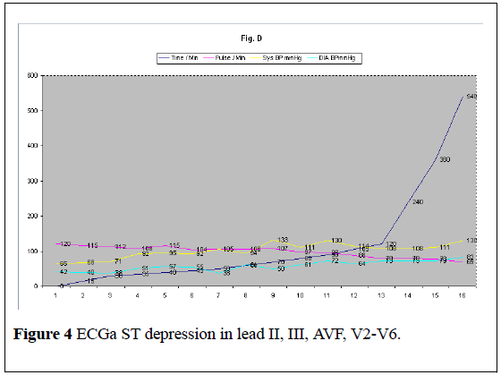 medical-toxicology-ECGa-ST-depression