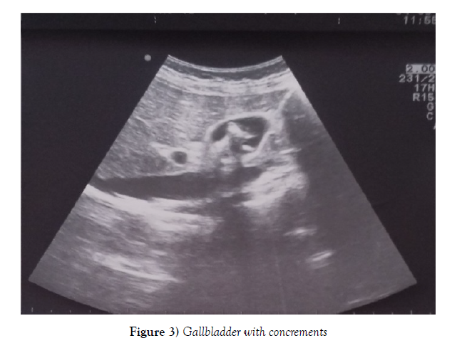 microbiology-biotechnology-reports-gallbladder-concrements