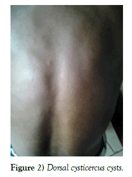 neurology-clinical-neuroscience-Dorsal-cysticercus