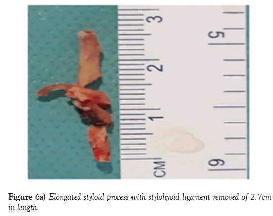 neurology-clinical-neuroscience-Elongated-styloid