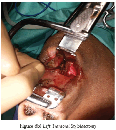 neurology-clinical-neuroscience-Left-Transoral