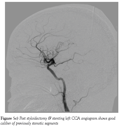 neurology-clinical-neuroscience-Post-styloidectomy