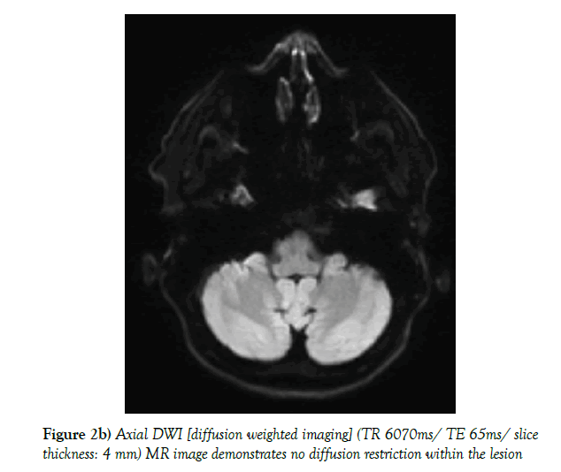 neurology-clinical-neuroscience-diffusion-restriction