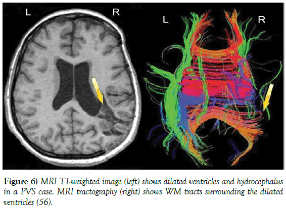 neurology-clinical-neuroscience-dilated-ventricles