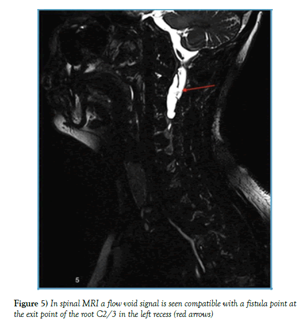 neurology-clinical-neuroscience-fistula-point