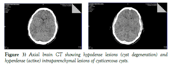 neurology-clinical-neuroscience-intraparenchymal-lesions