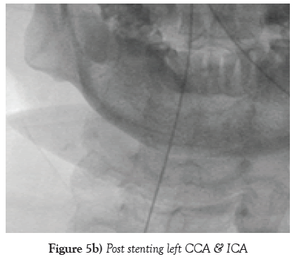 neurology-clinical-neuroscience-stenting-left