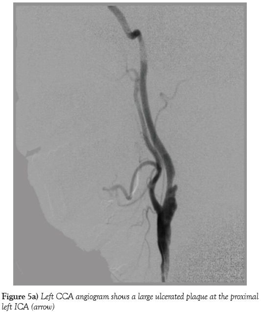 neurology-clinical-neuroscience-ulcerated-plaque