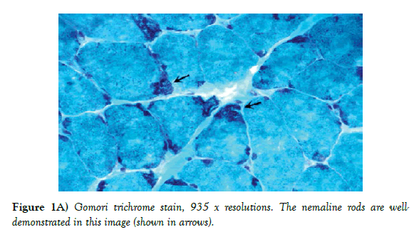 neuropathology-Gomori-trichrome