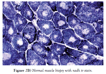 neuropathology-muscle-biopsy