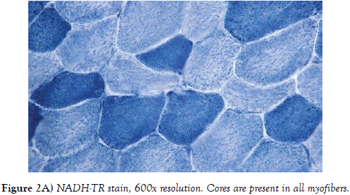 neuropathology-myofibers