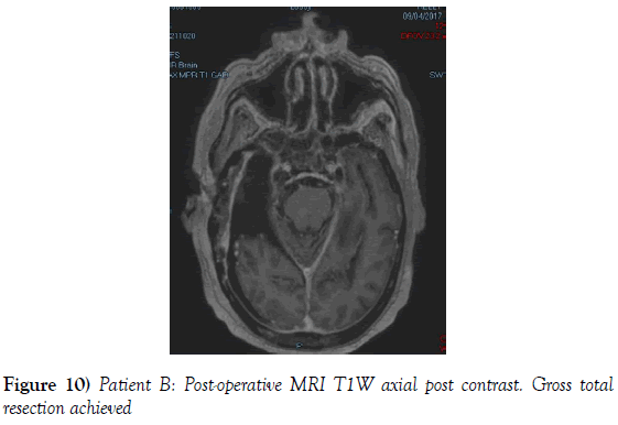 neurosurgery-MRI-T1W-axial