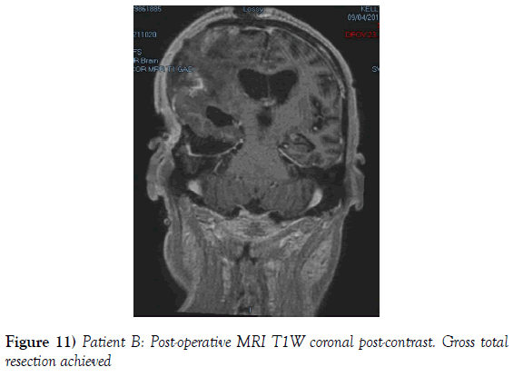 neurosurgery-MRI-T1W-coronal-post-contrast