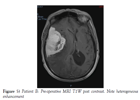 neurosurgery-MRI-T1W-post-contrast