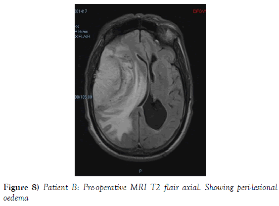 neurosurgery-Showing-peri-lesional
