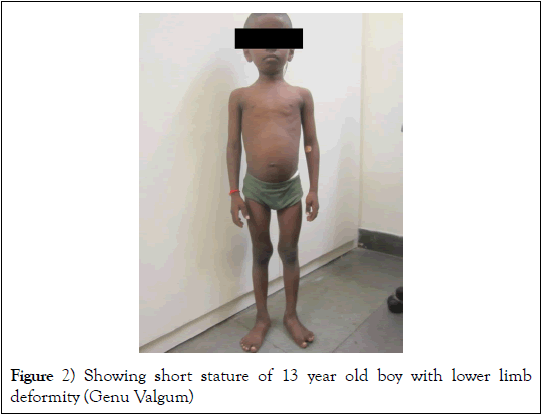 pediatric-health-care-medicine-short-stature