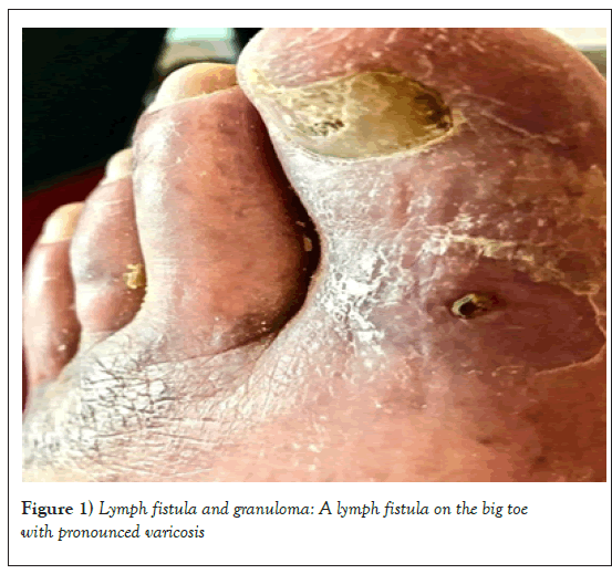 phlebology-lymphology-fistula