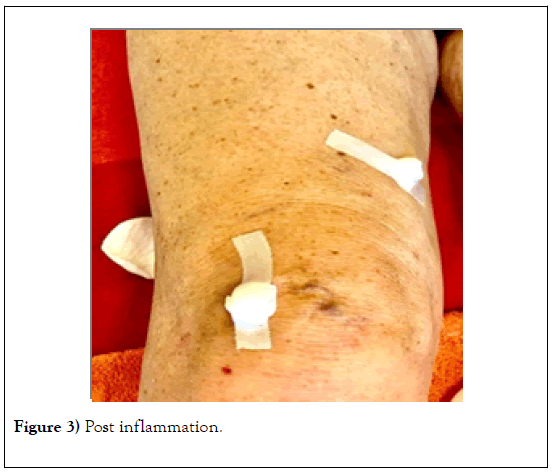 phlebology-lymphology-inflammation