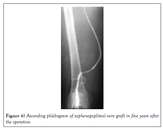 phlebology-lymphology-phlebogram-saphenopopliteal