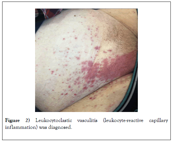 phlebology-lymphology-vasculitis