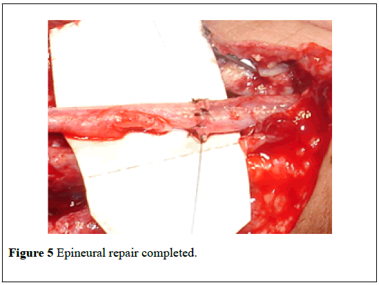 pulsus-journal-surgical-research-Epineural-repair