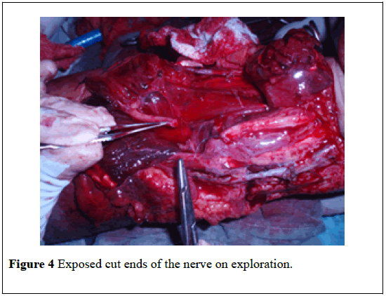 pulsus-journal-surgical-research-Exposed-cut-ends