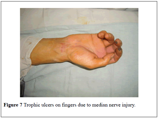 pulsus-journal-surgical-research-Trophic-ulcers
