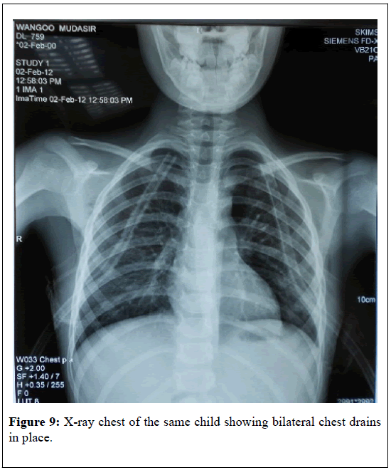 pulsus-journal-surgical-research-bilateral-chest