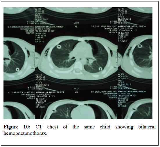 pulsus-journal-surgical-research-hemopneumothorax