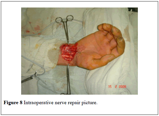 pulsus-journal-surgical-research-nerve-repair-picture