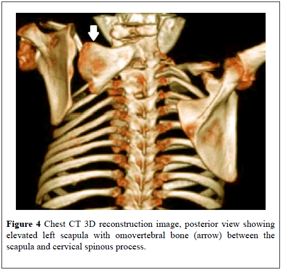 pulsus-journal-surgical-research-omovertebral-bone