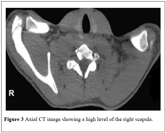 pulsus-journal-surgical-research-right-scapula