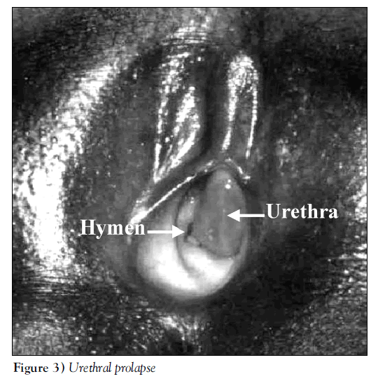 sexual-reproductive-medicine-Urethral-prolapse